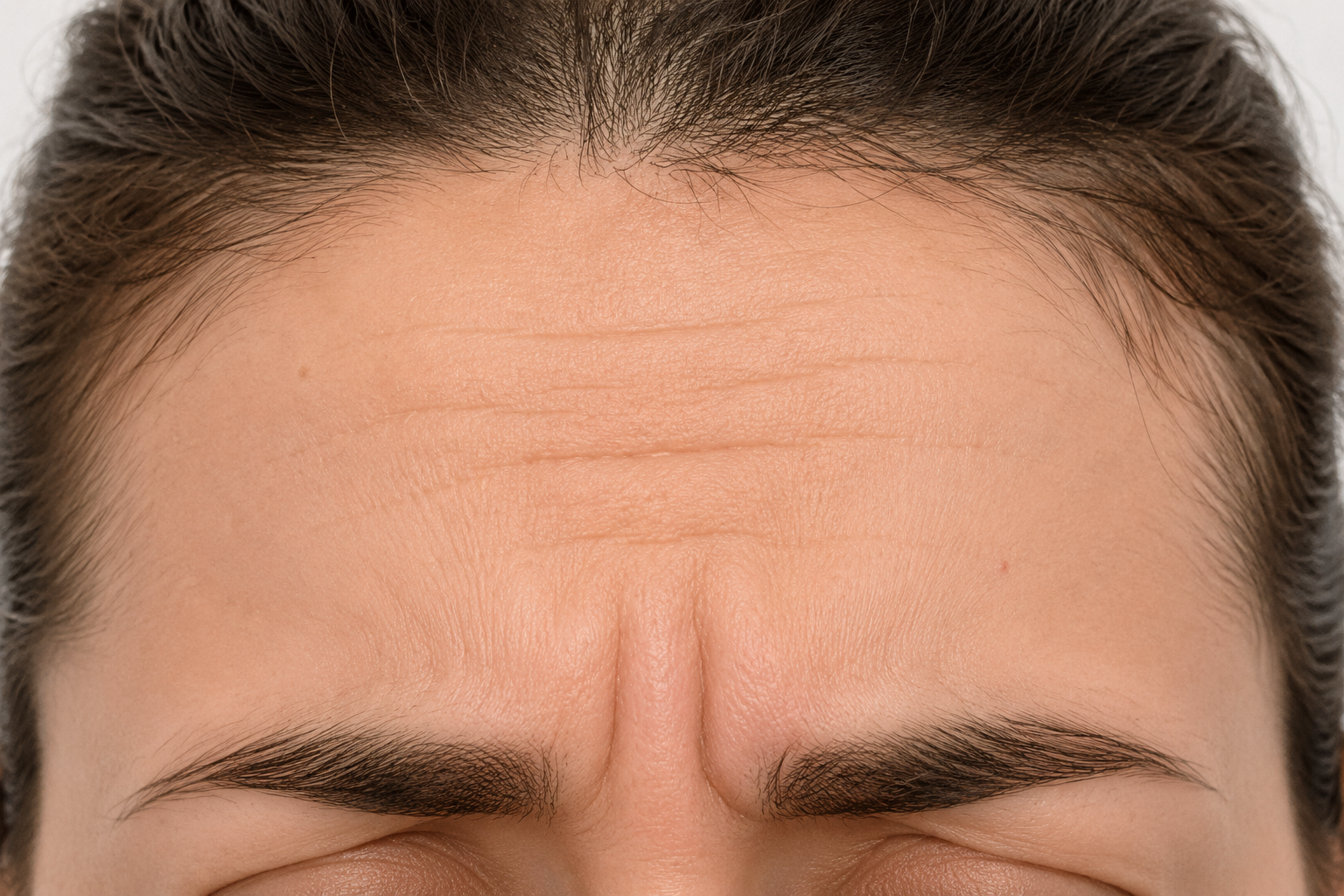 Forehead Botox — after