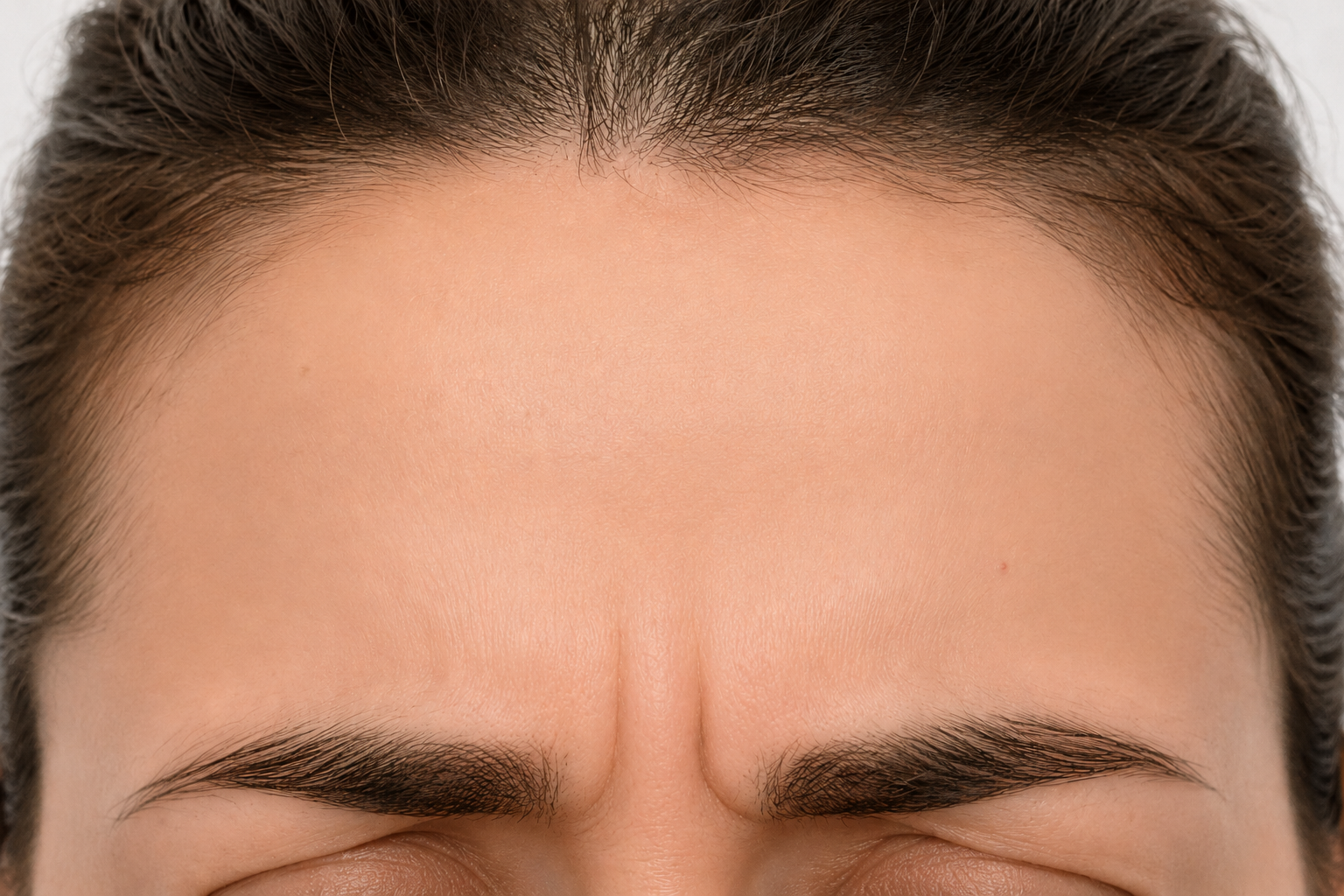 Forehead Botox — before