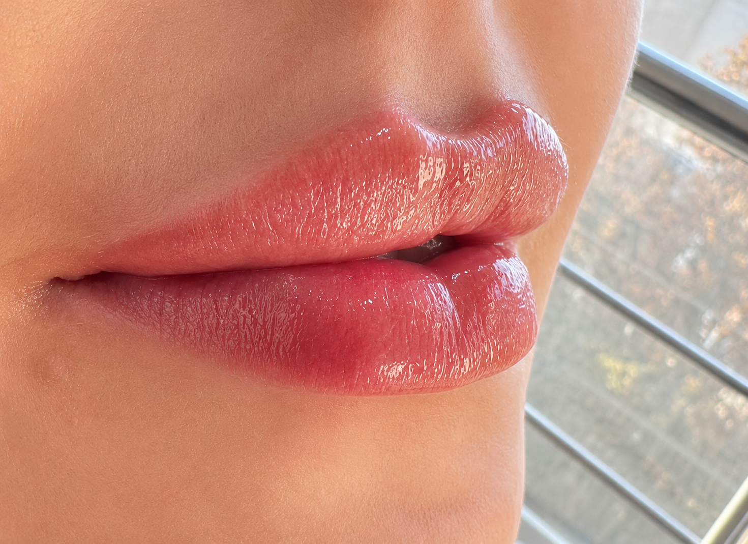 Lip Enhancement — after