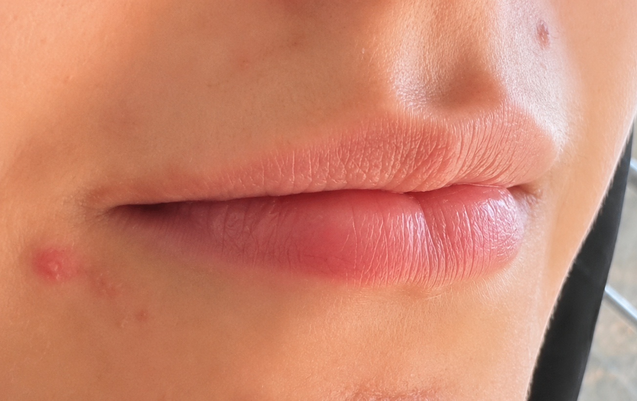 Lip Enhancement — before