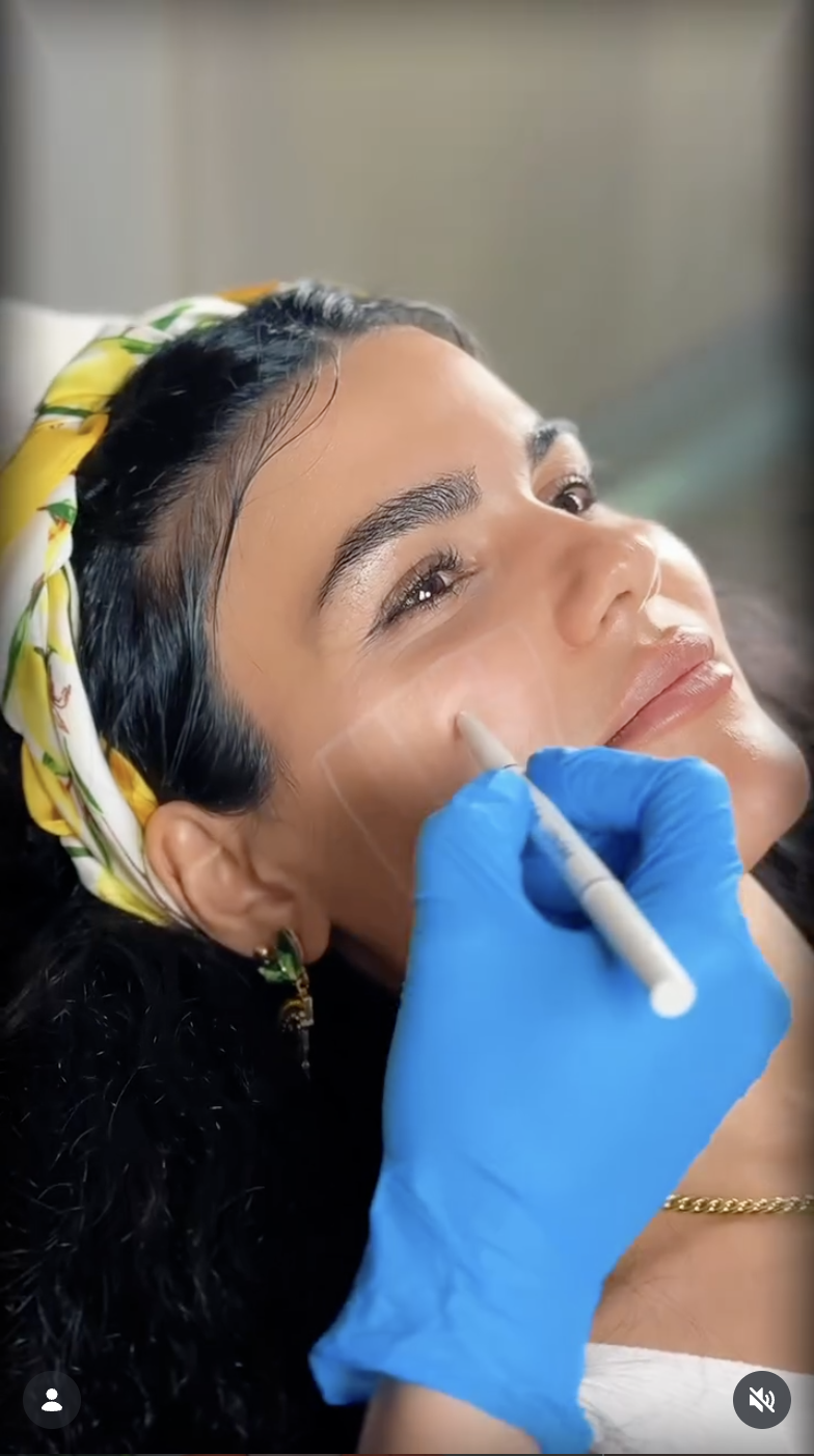 Botox Treatments